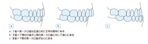 アングルの分類、両顎手術の説明