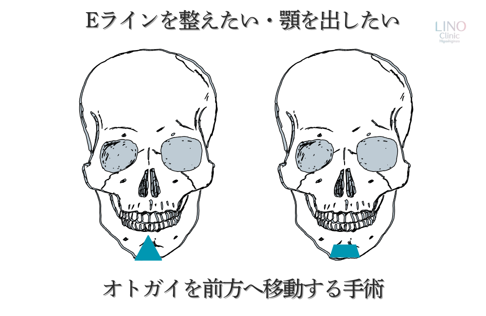  「オトガイ形成によるEラインの整え方。顎を前方に出す手術。 
