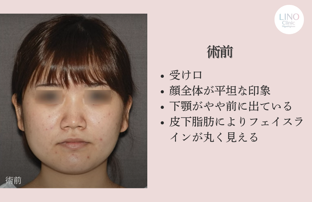 骨切り手術前の患者様（正面）