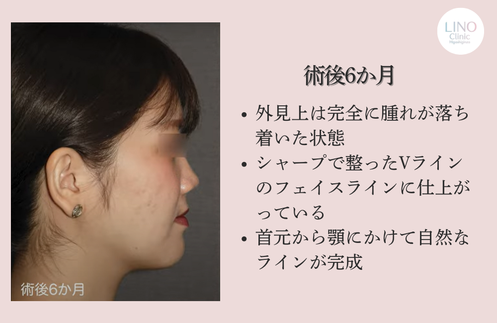 輪郭形成6か月後の横顔
