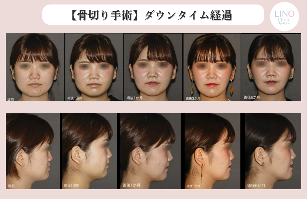 骨切り手術のダウンタイム経過