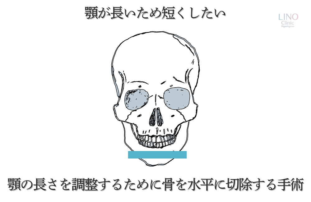 顎が長い場合の骨切り手術。横に切ることで顎の長さを調整