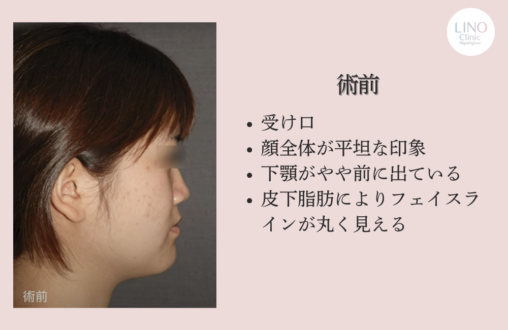 骨切り手術前の患者様（横顔）
