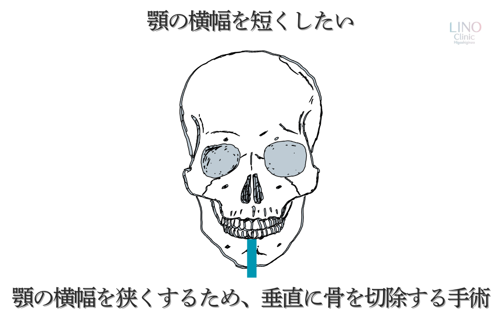 顎の幅を狭くする手術。縦に切ることでシャープなフェイスラインを実現