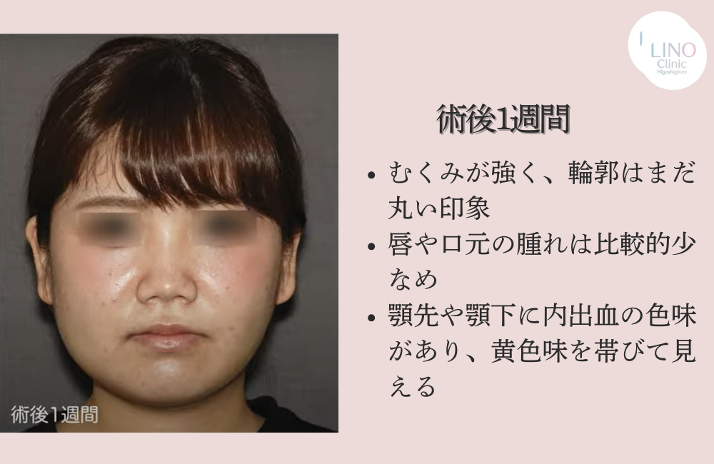 骨切り手術ダウンタイム1週間目（正面）
