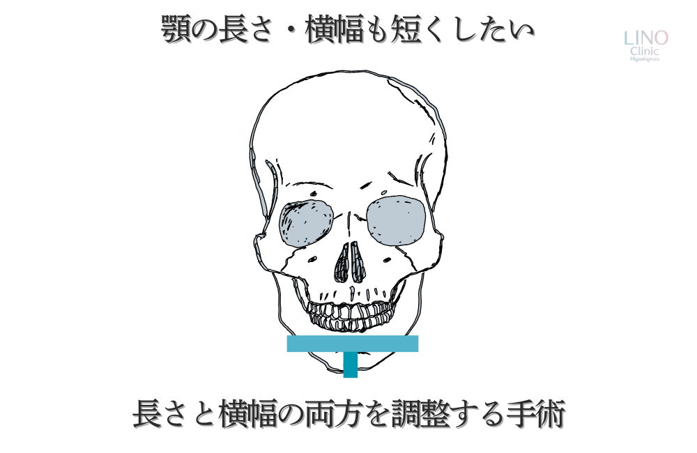 顎の長さと幅を調整する手術。縦と横を同時に切ることで理想的なオトガイに