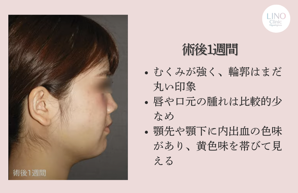 輪郭形成手術から1週間後（横顔）