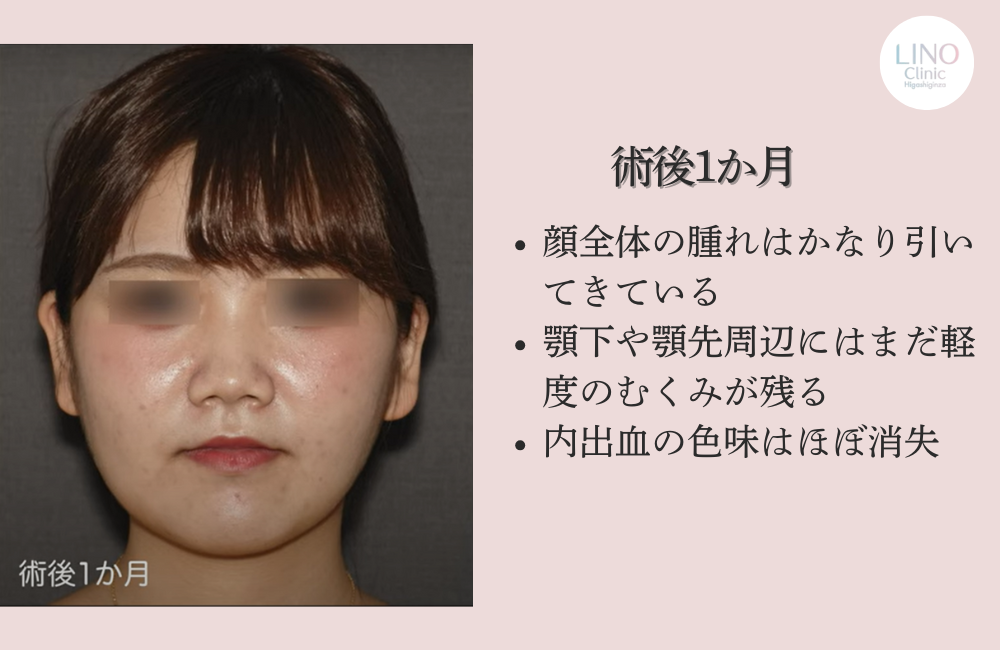 骨切り手術1か月後の正面写真