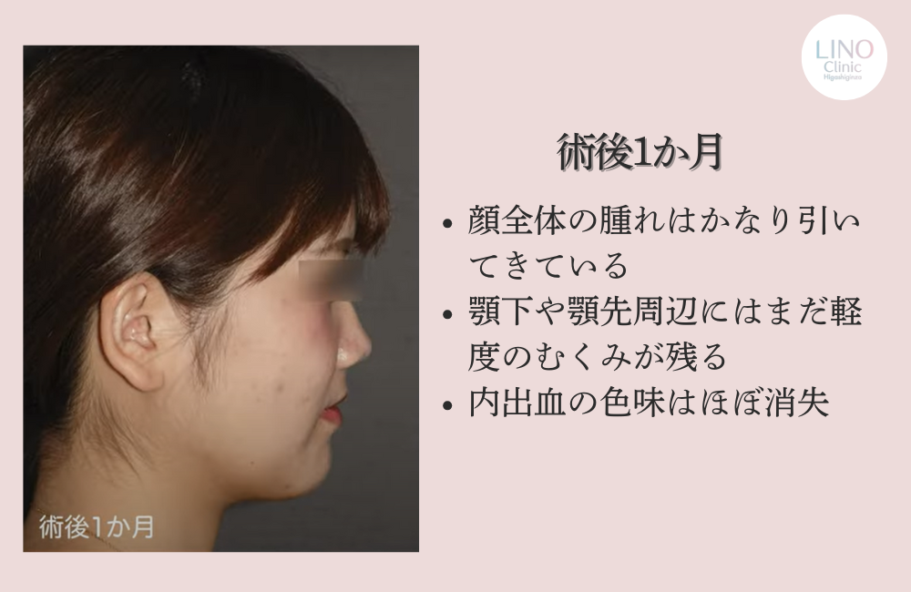 骨切り＋顎形成術から1か月
