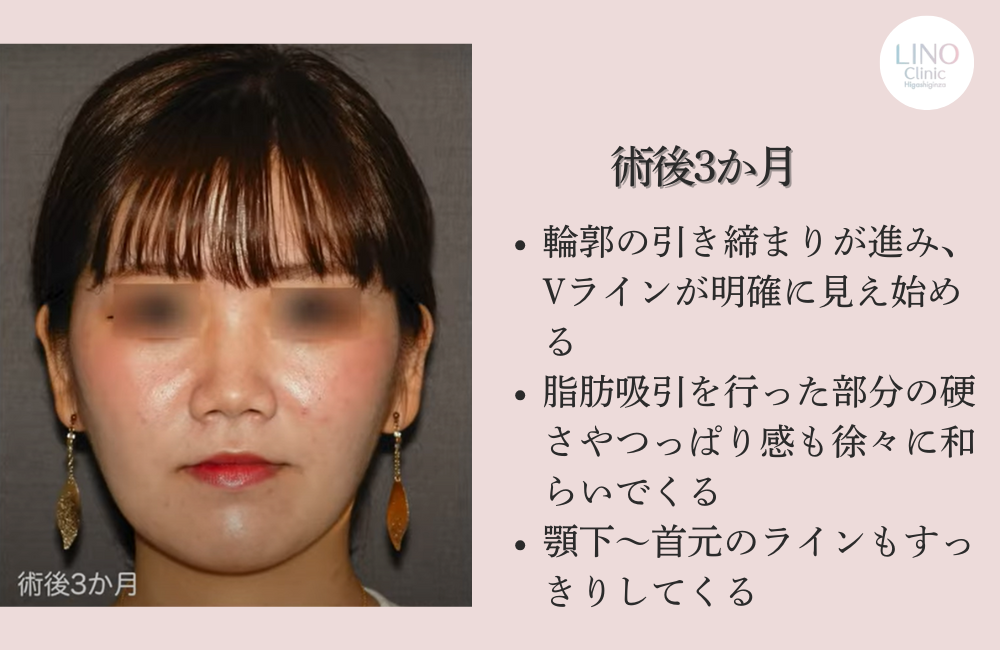 輪郭形成手術3か月後（正面）