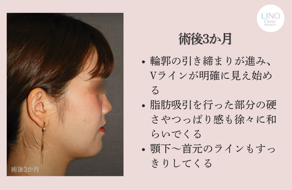 骨切り＋顎下脂肪吸引後3か月の横顔