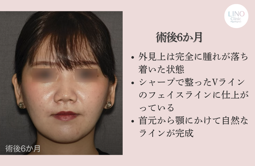 骨切り手術ダウンタイム6か月後（正面）