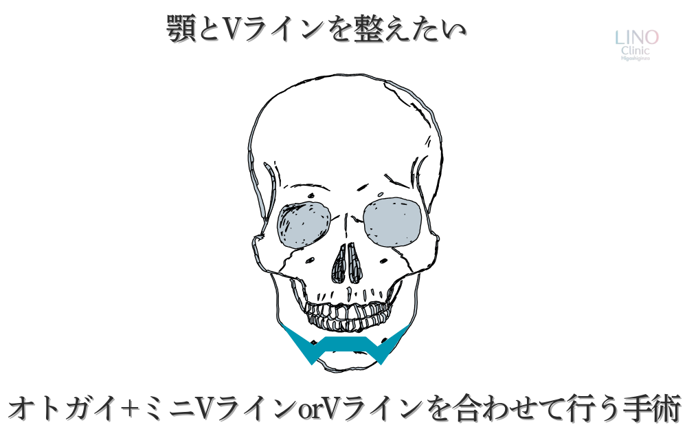 VラインやミニVラインを組み合わせたオトガイ形成