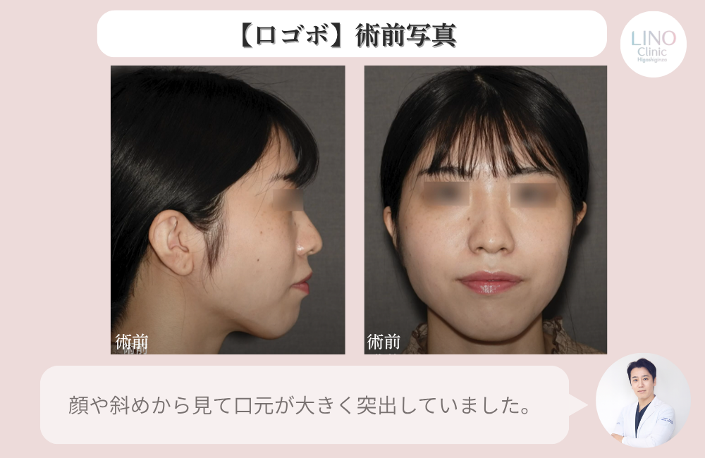 ゴボ口の治し方は骨切り手術で。正面と横顔の術前写真