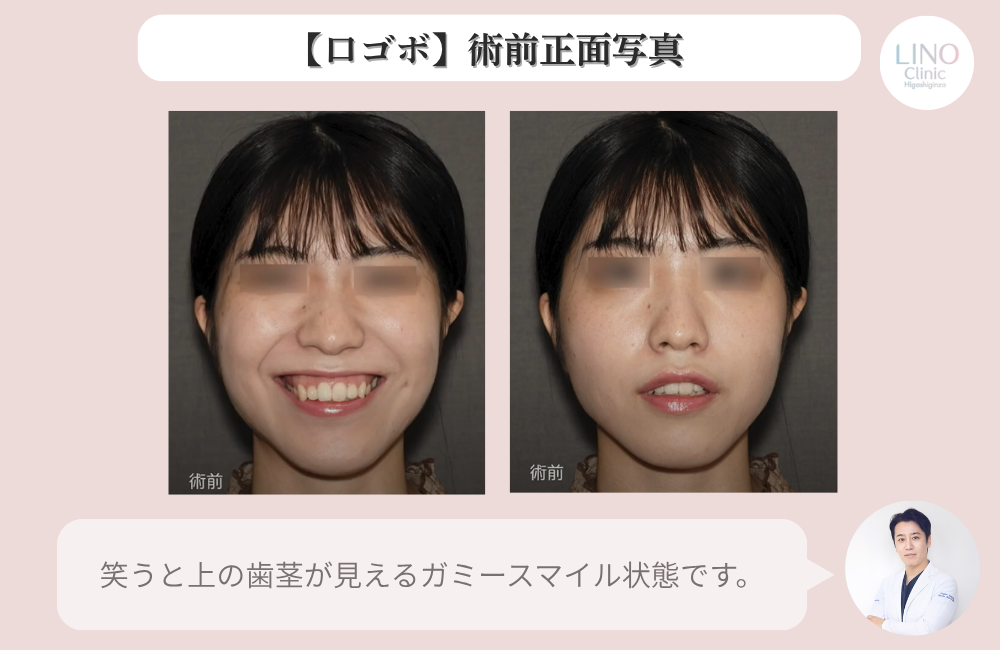 骨切り手術前のゴボ口改善例。正面の比較写真