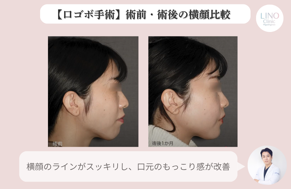 骨切り手術後の横顔。下唇から顎にかけてシャープなラインに改善