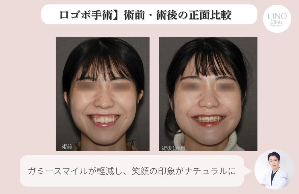 骨切り術後の正面写真。顎のラインがV字型に近づいた様子