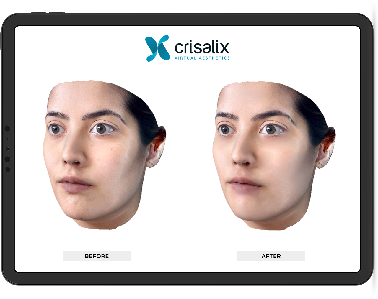 輪郭整形の仕上がりをCrisalixで360°シミュレーション