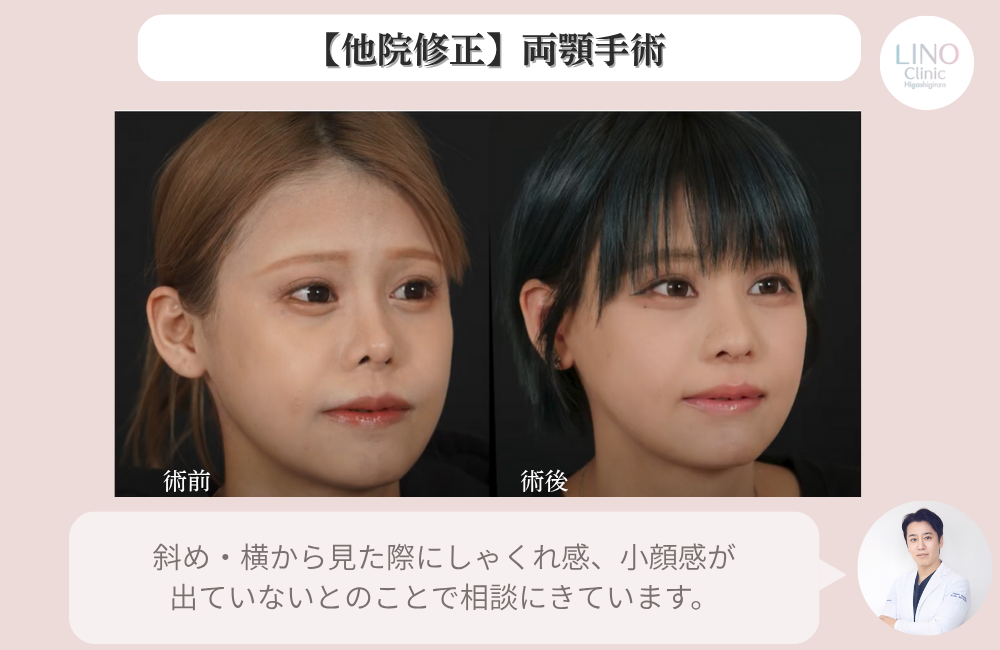 他院修正症例、輪郭3点を行っていたが当院で両顎手術を行いました。