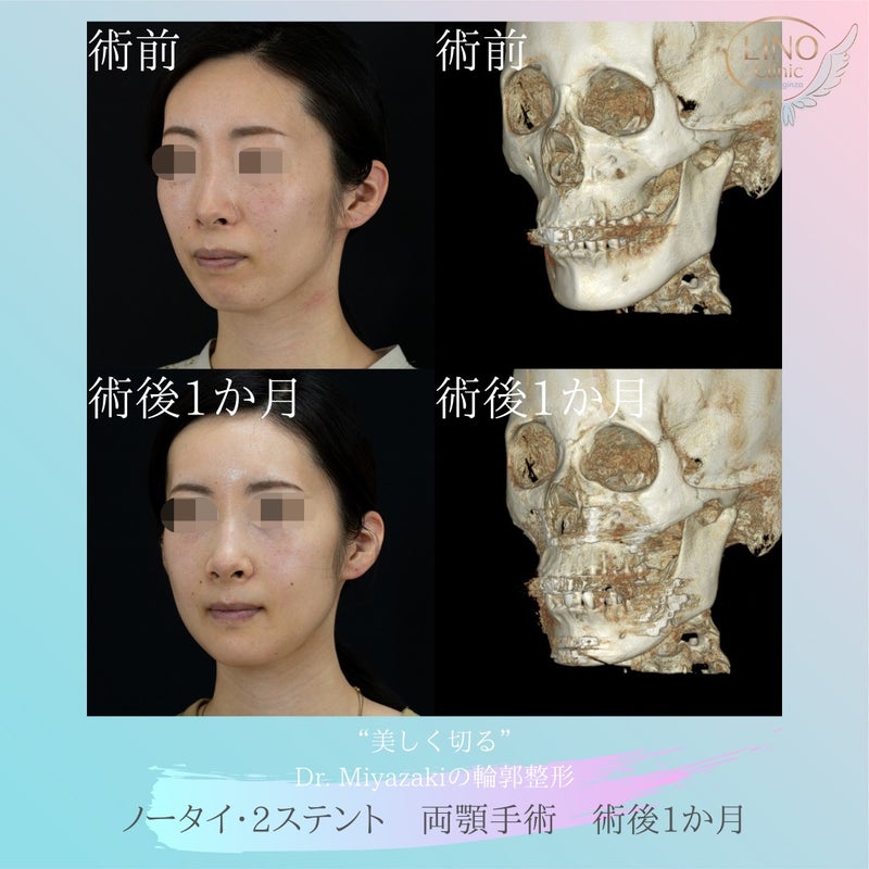 両顎手術とオトガイ形成