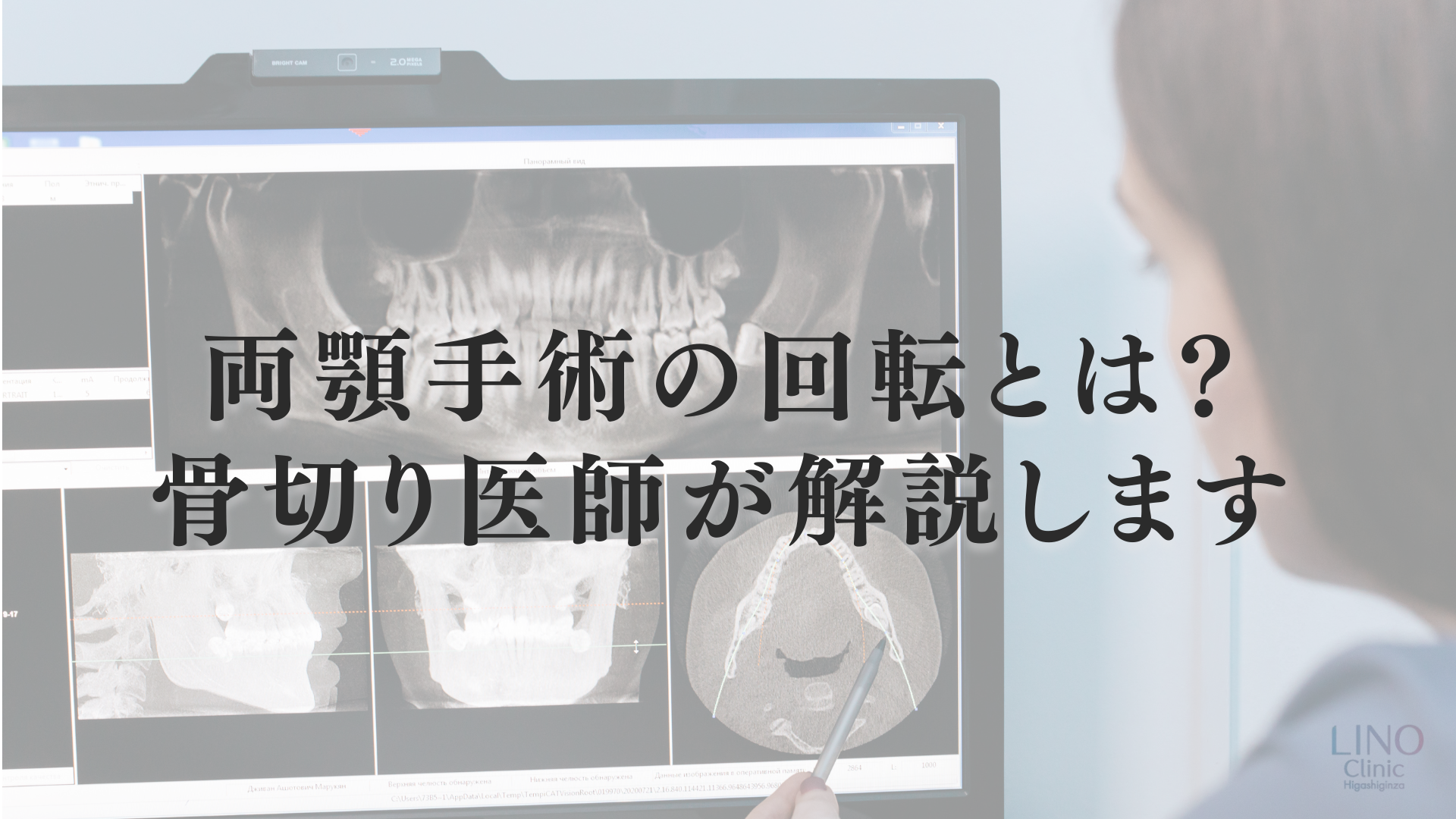 両顎手術の「回転」とは？時計回転・反時計回転の違いと顔の変化を医師が解説