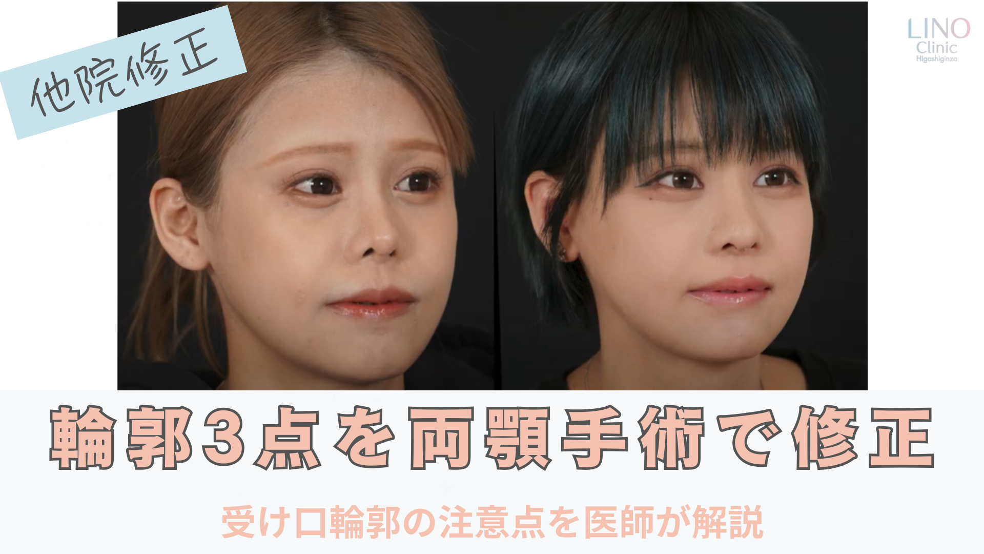 Vライン・輪郭3点手術の修正で後悔しないために｜受け口輪郭の注意点を医師が解説