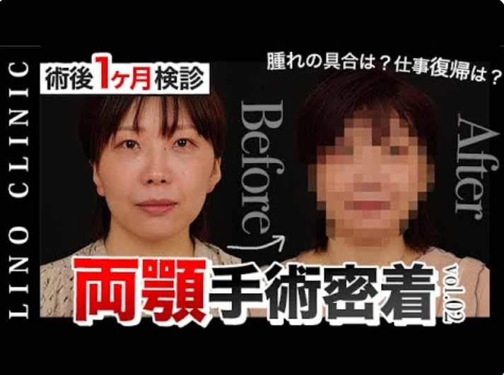 両顎手術1ヶ月のダウンタイムがやばい｜痛み・腫れ・食事としびれの真実