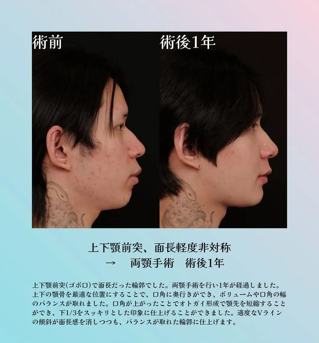 上下顎前突(ゴボ口)の輪郭