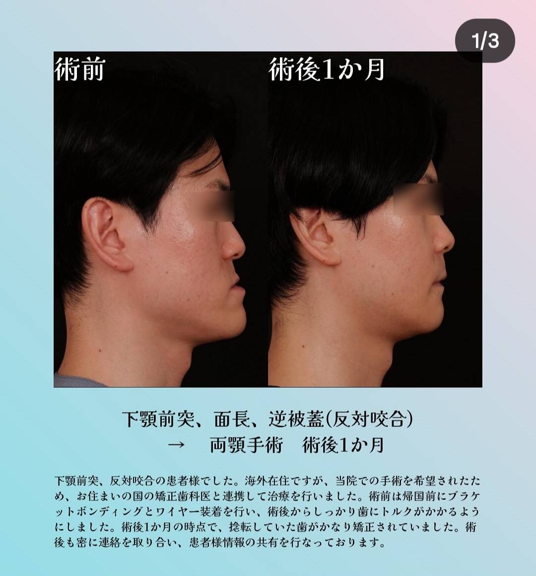 男性の輪郭整形