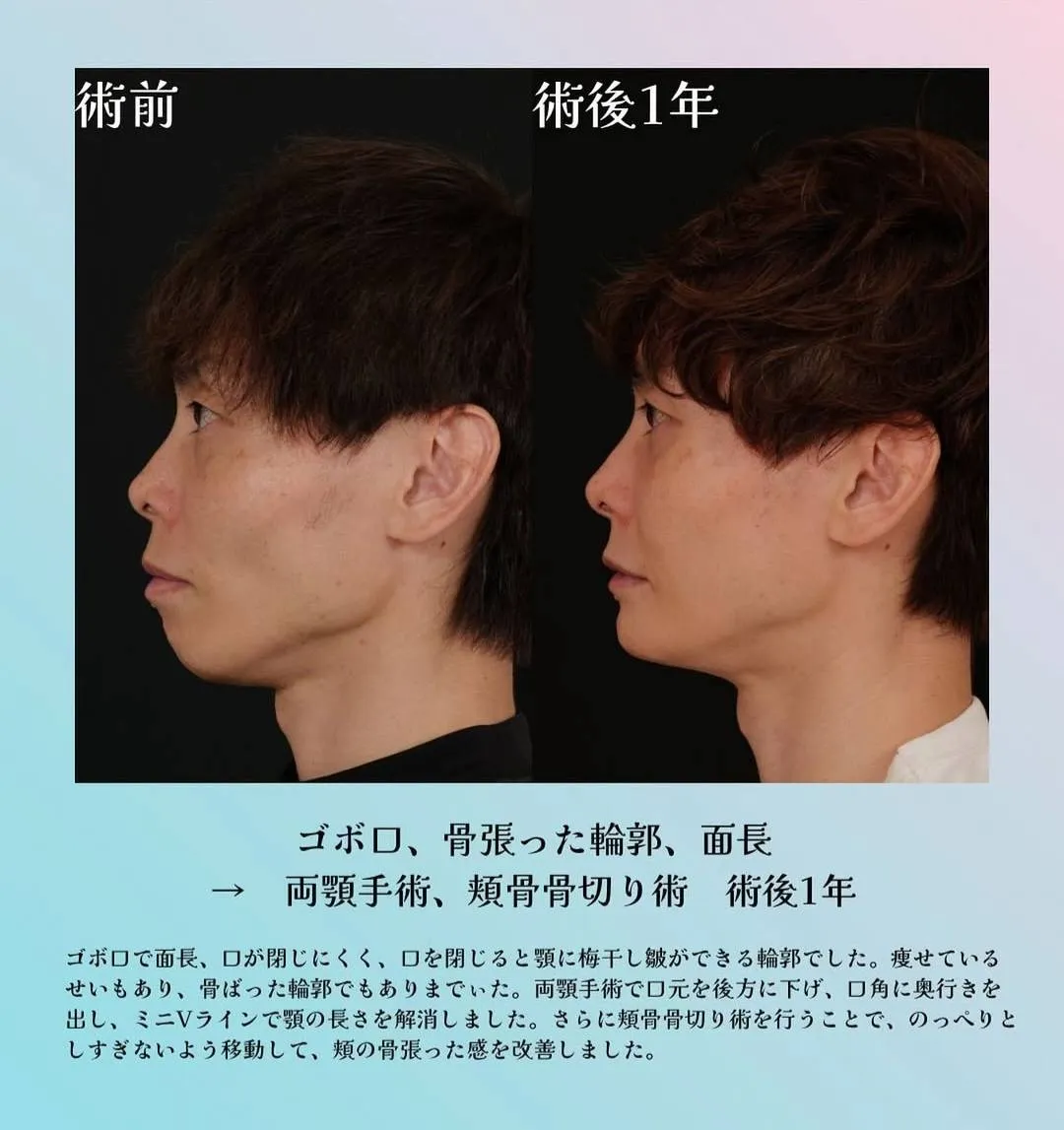 男性の輪郭整形