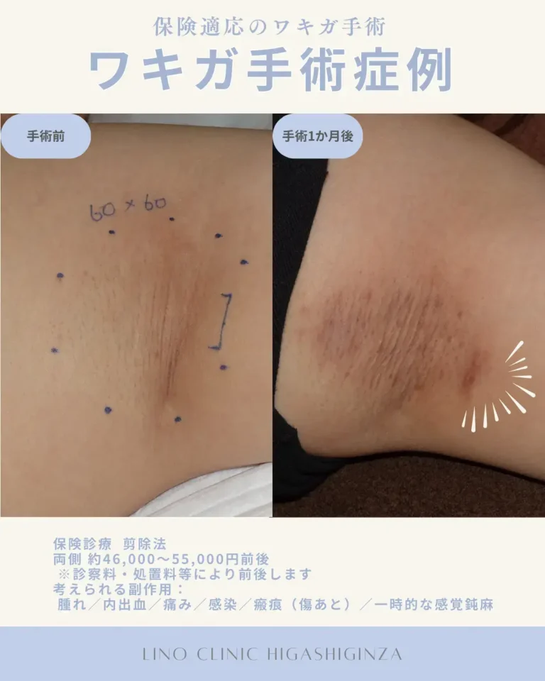 ワキガ治療症例
