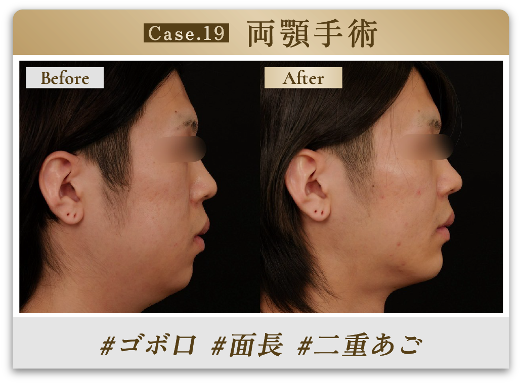 #ゴボ口 #面長 #二重あご