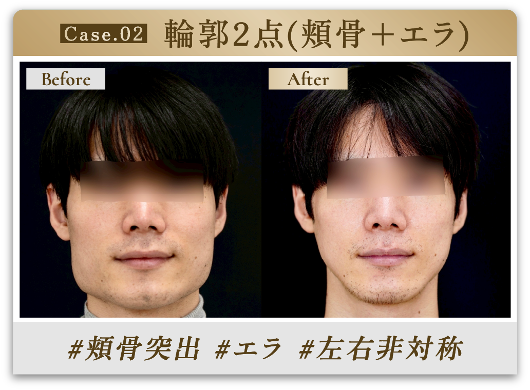 #頬骨突出 #エラ #左右非対称