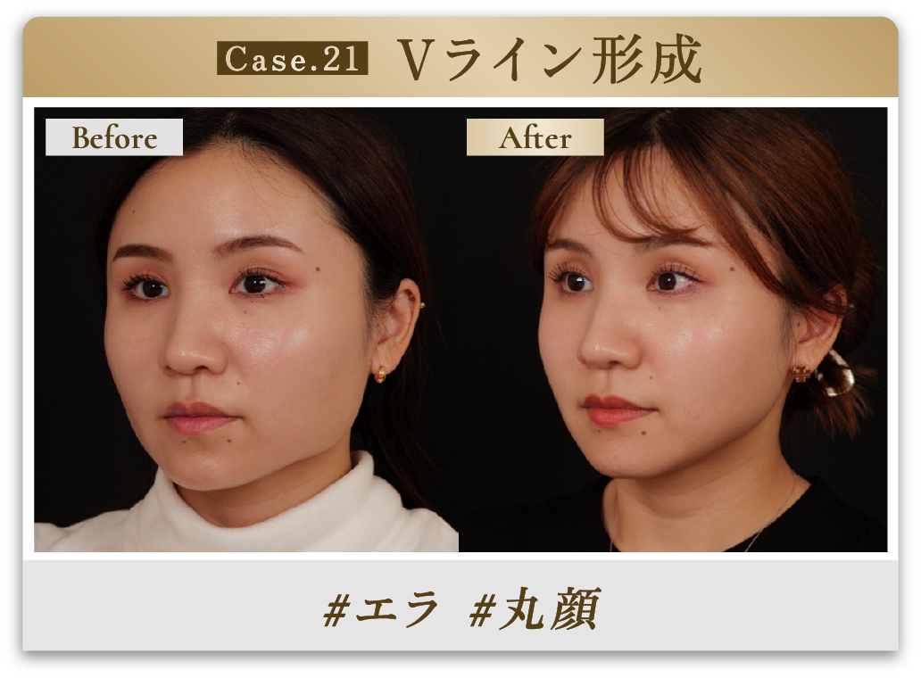 #エラ #丸顔