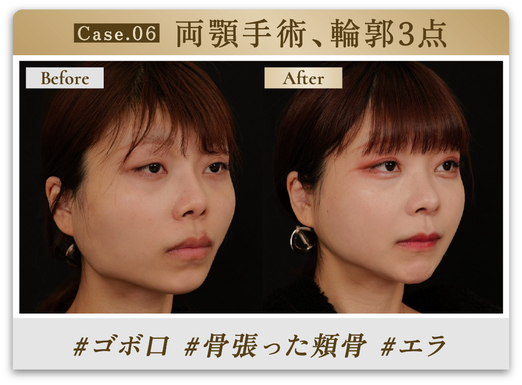 #ゴボ口 #骨張った頬骨 #エラ
