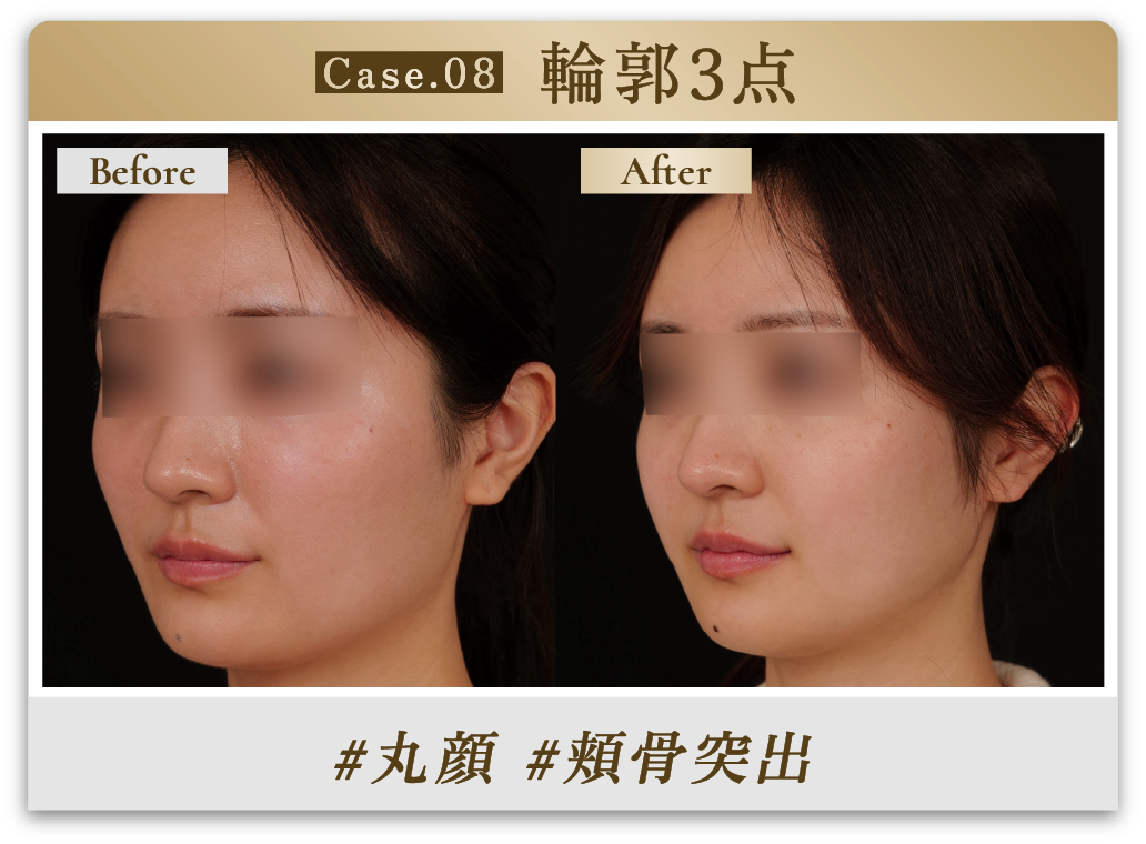 #丸顔 #頬骨突出