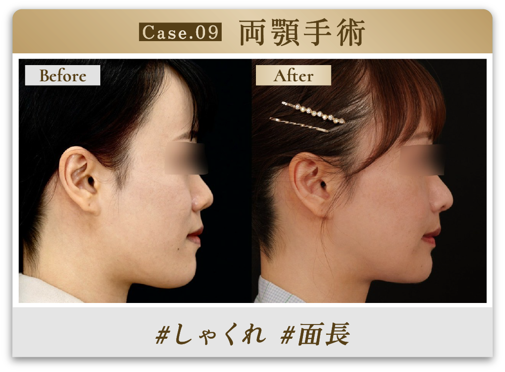 #しゃくれ #面長
