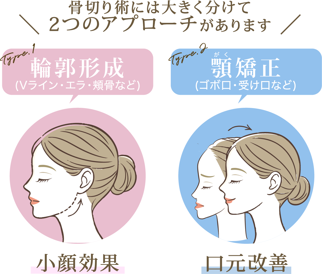骨切り術には大きく分けて2つのアプローチがあります